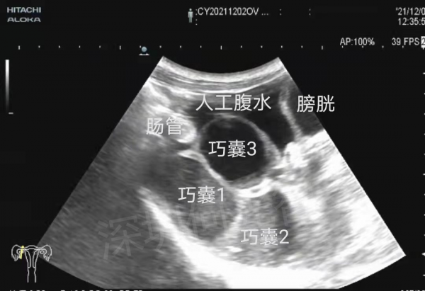 女子盆腔深部長多個巧克力囊腫，超聲介入硬化治療後囊腫消失