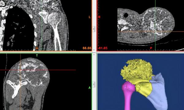 男生左肩長了小腫塊，3個月後變足球大小相當驚人，醫生：很常見