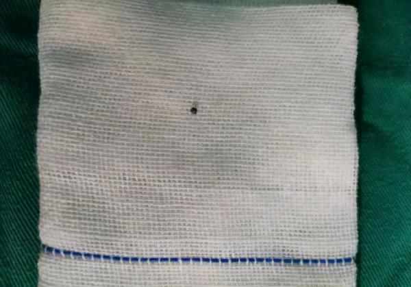 險！電焊金屬碎屑射進耳朵，醫生精細探查妙手“取彈”