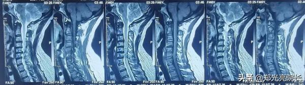 頸椎病保健“三步曲”