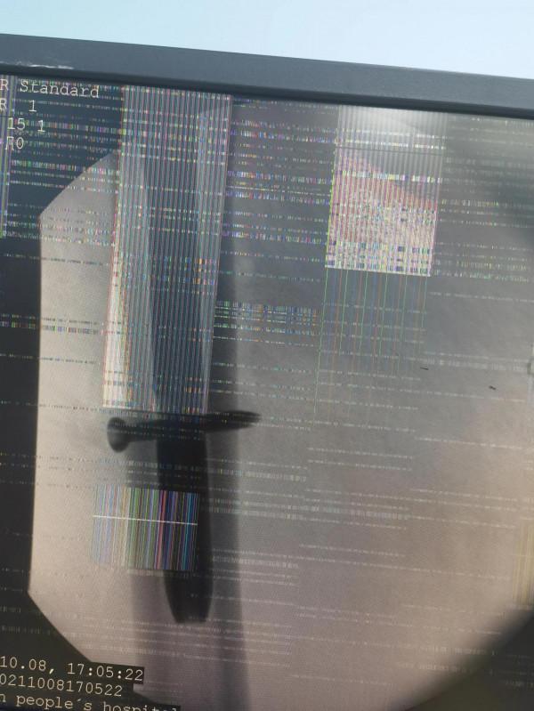 股骨轉子間骨折一例