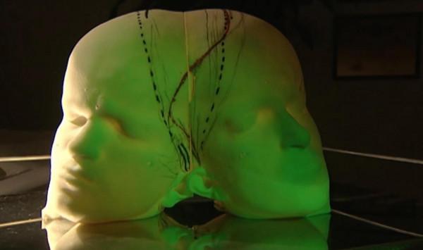 伊朗著名連體雙胞胎姐妹，29歲冒險做分離手術，分開兩小時殞命