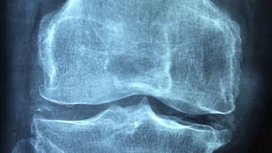 天天補鈣還得骨質疏鬆？因為這幾件事沒做好