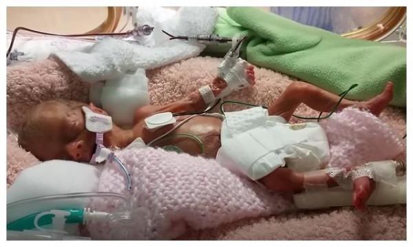 26周早產兒，出生不到1斤只有巴掌大，奇蹟生還長成大美人