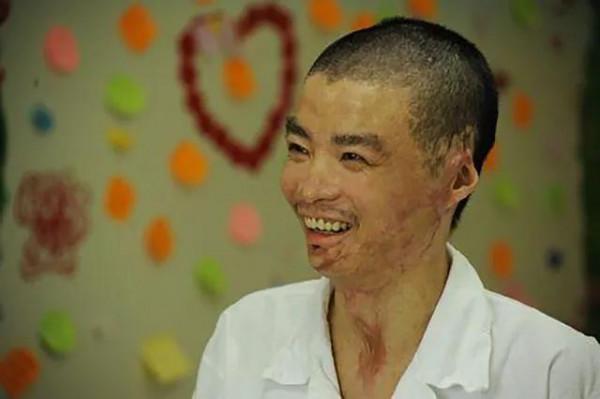 他以血肉之軀浴火救44人,燒傷達90%,後娶美嬌妻,結局幸福圓滿 他以血肉之軀浴火救44人,燒傷達90%,後娶美嬌妻,結局幸福圓滿