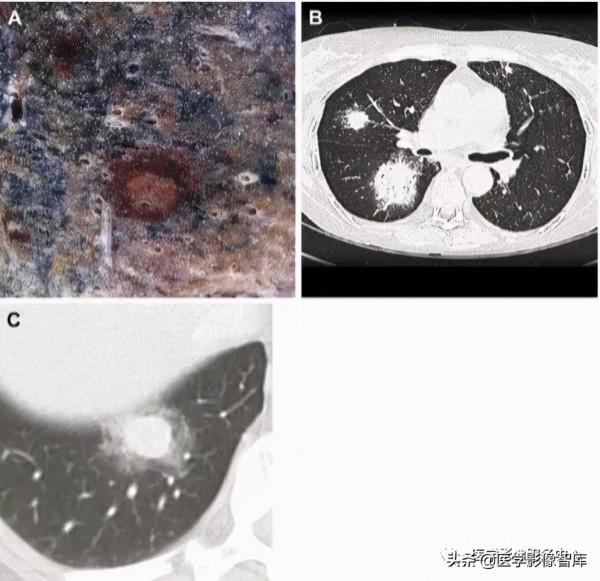 22個肺部疾病的CT徵象 22個肺部疾病的CT徵象