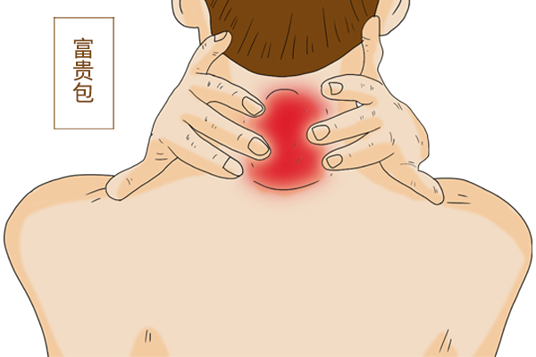 脖子後面長了個包，到底是“富貴包”還是“奪命包”？該怎麼辦？