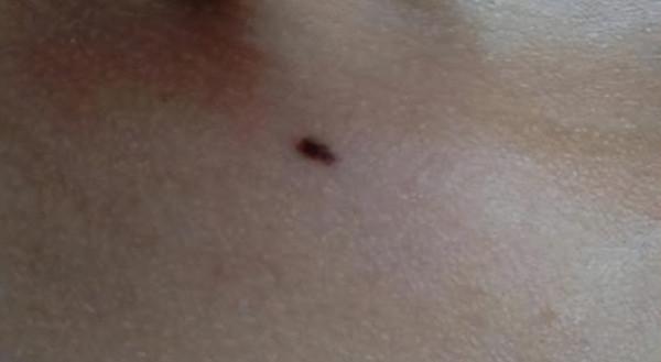 醫生提醒：若黑痣長在這4個部位，要密切關注，及早做檢查