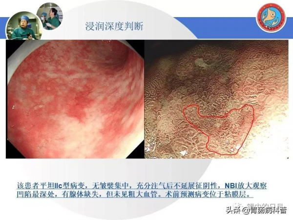 早期胃癌——內鏡診治流程