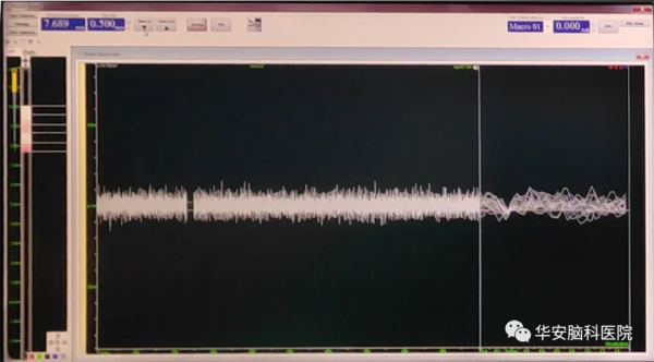 「跨省求醫」華安腦科醫院成功開展首例DBS手術治療梅傑綜合徵