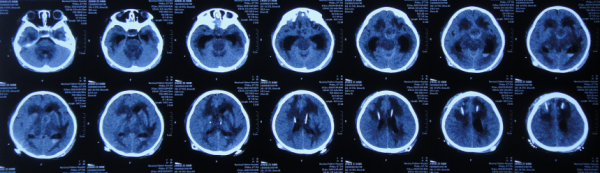 顱內生殖細胞瘤切除術後腦積水仍反覆,意識模糊,左側肢體偏癱 顱內生殖細胞瘤切除術後腦積水仍反覆,意識模糊,左側肢體偏癱