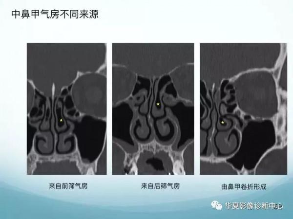 頭頸五官CT斷層解剖圖及常見病影像診斷
