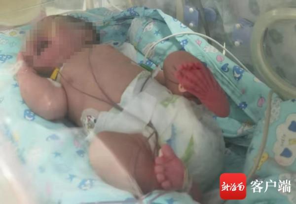 驚險！寶寶出生後產生大量心包積液 醫生3小時摘除&OpenCurlyDoubleQuote;炸彈&rdquo;轉危為安