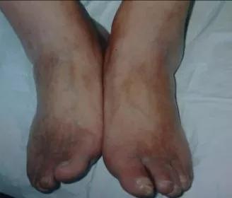 五體痺中脈痺如何治療呢? 五體痺中脈痺如何治療呢?