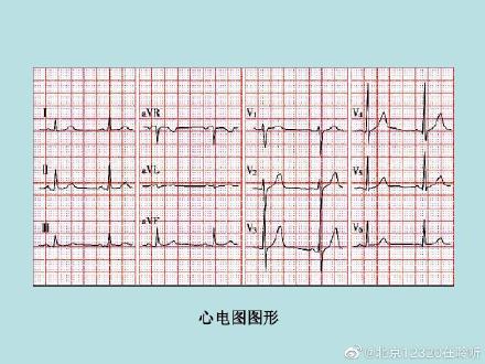 如何讀懂心電圖？