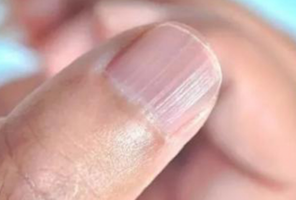 指甲蓋上有豎紋，是咋回事？真是老人說的“肝臟不好”嗎？瞭解下