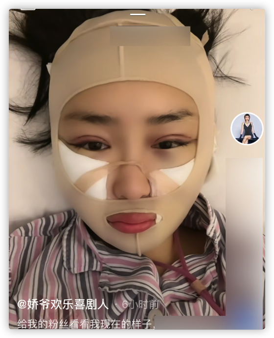 本山傳媒嬌嬌自曝整容，曬術後照被指認不出，多次割眼皮腫脹明顯