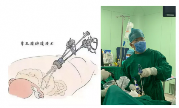 &OpenCurlyDoubleQuote;一孔之術&rdquo;，帶您瞭解婦科微創手術