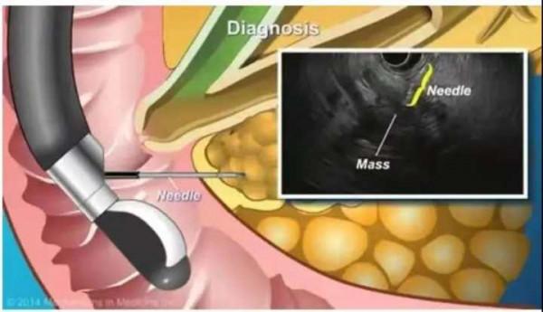 浙中醫大二院開展首例超聲內鏡引導下細針穿刺抽吸術,一根細針辨病因 浙中醫大二院開展首例超聲內鏡引導下細針穿刺抽吸術,一根細針辨病因