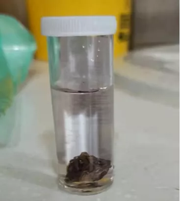 異物嗆入支氣管「越陷越深」,1種方法快速自救 異物嗆入支氣管「越陷越深」,1種方法快速自救