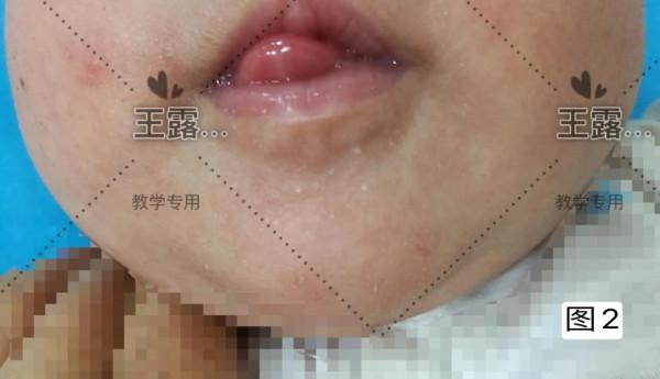 新生兒一過性面板病（二）～粟丘疹