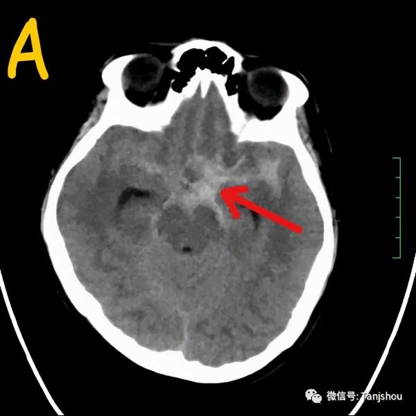 帶你認識“顱內炸彈”