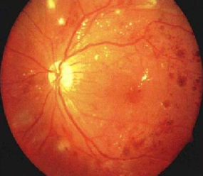 感染性心內膜炎（上）