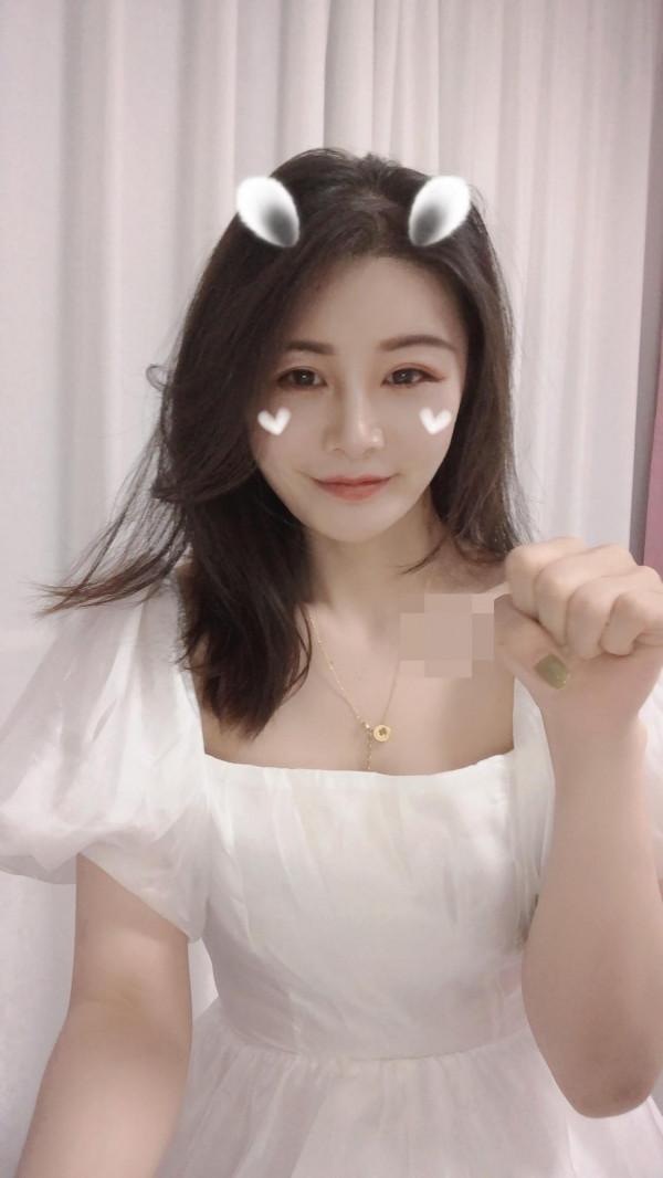 33歲老阿姨做完自體脂肪面部填充60天,閨蜜說我年輕了不止10歲 33歲老阿姨做完自體脂肪面部填充60天,閨蜜說我年輕了不止10歲