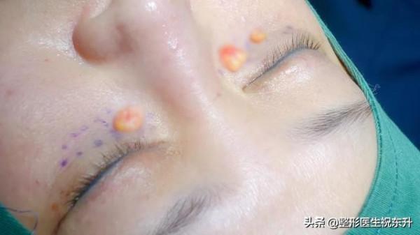 聽醫生淺談：關於“內切祛眼袋手術”的那些事