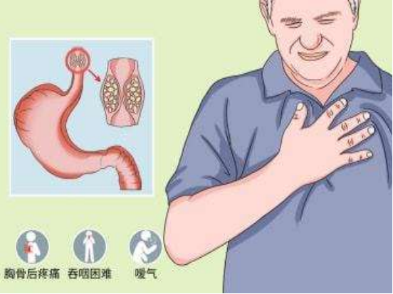 59歲男子咽喉乾燥、發癢，自以為&OpenCurlyDoubleQuote;咽炎&rdquo;，醫院檢查後男子崩潰了