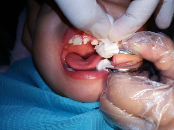 5歲娃牙齒幾乎全黑,罪魁禍首卻不是糖果 5歲娃牙齒幾乎全黑,罪魁禍首卻不是糖果