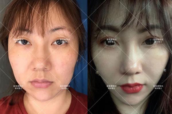 38歲小拉皮術後5個月,跟大家說一說我的經歷 38歲小拉皮術後5個月,跟大家說一說我的經歷