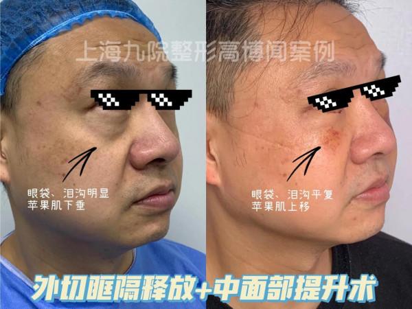 聽說你要做祛眼袋/眶隔釋放了?這些事你知道了嘛? 聽說你要做祛眼袋/眶隔釋放了?這些事你知道了嘛?