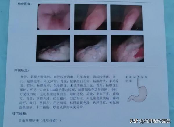 「真實案例」31歲偶爾腹脹，一次意外的胃鏡，竟然救了她一命