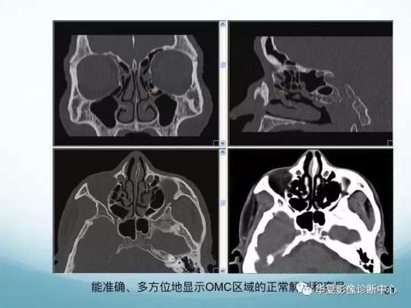 頭頸五官CT斷層解剖圖及常見病影像診斷