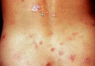 人們不要把二期梅毒“銀屑病樣疹”,誤認為銀屑病 人們不要把二期梅毒“銀屑病樣疹”,誤認為銀屑病