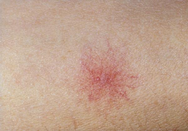 肝炎有哪些症狀你知道嗎？