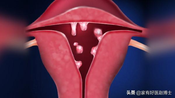 最常見5類息肉每個人都可能有，哪些無癌變風險，哪些需要切除？