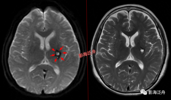 VR腔隙、腔梗灶、微出血、脫髓鞘，傻傻分不清？快看這裡