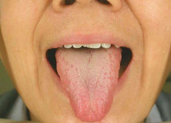 名老中醫嚴世芸特效方分享，辯證治療高血壓，對這些證型更有效