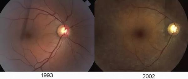 服用羥氯喹治療類風溼關節炎，為何患者的眼睛逐漸看不清？