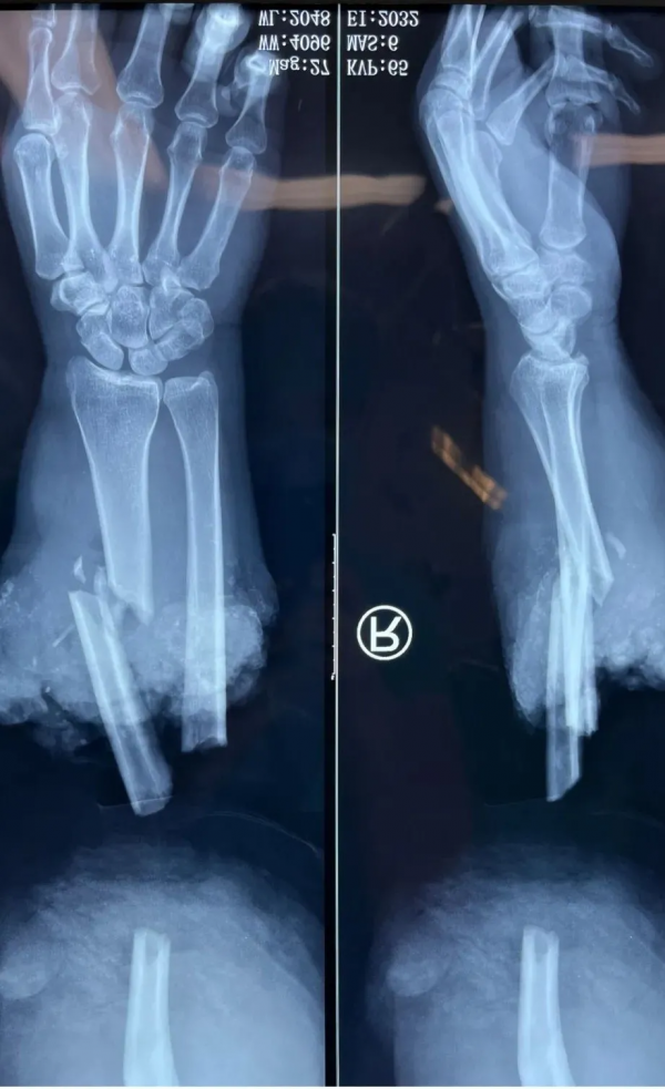 6小時徹夜奮戰保肢成功——北京積水潭醫院手外科完成2022年首例斷肢再植手術
