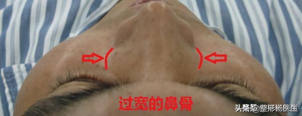 粉絲留言說到:捏鼻樑就能把鼻子捏高?真的嗎?整形醫生給你解答 粉絲留言說到:捏鼻樑就能把鼻子捏高?真的嗎?整形醫生給你解答