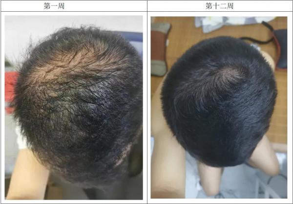 生髮第十二週 生髮第十二週