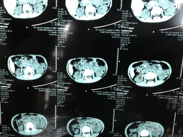 鍾量 | 兒童腎結石F4.8針式腎鏡PCNL碎石術