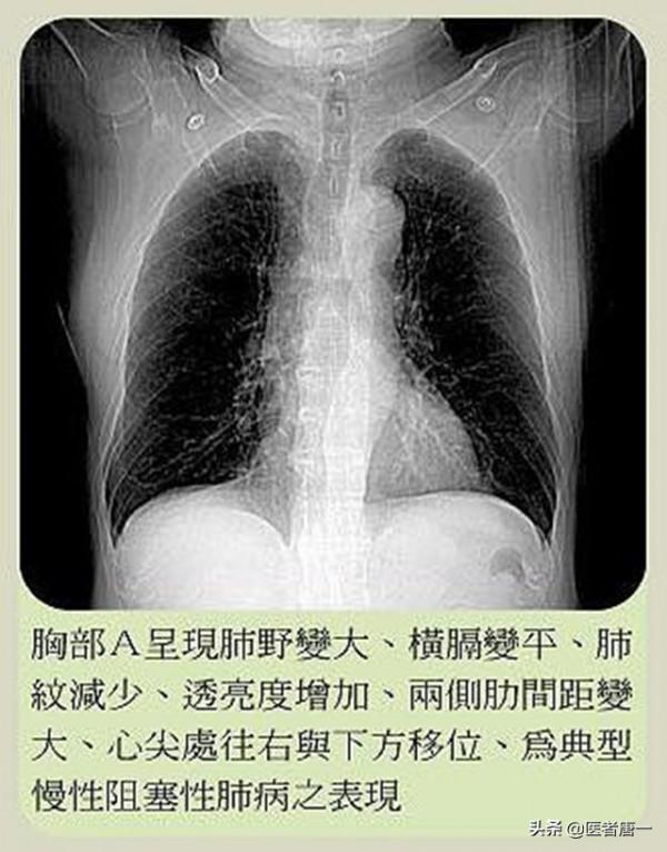 慢性肺病的朋友,建議你鍛鍊膈肌,膈肌是呼吸的發動機 慢性肺病的朋友,建議你鍛鍊膈肌,膈肌是呼吸的發動機