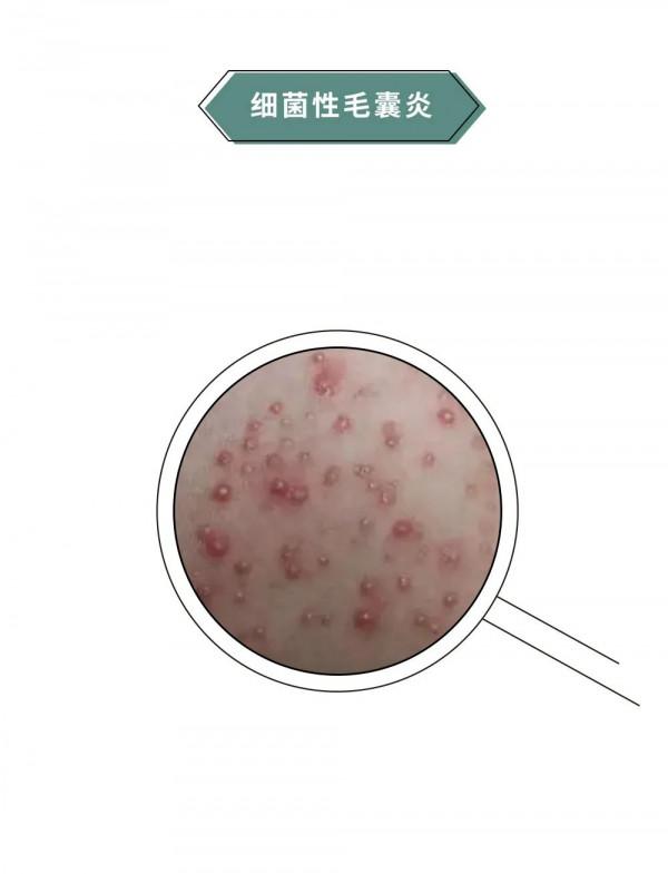 漫畫科普：“揹負”太多，“疹”的很累！