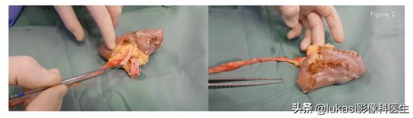 單個腎臟並且長了13個腫瘤，上帝之手給他做了自體腎移植。震撼