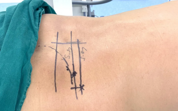 低溫等離子射頻消融術治療腰椎間盤突出，“一針”解除疼痛