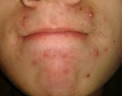 為什麼別人不長痘痘就我長